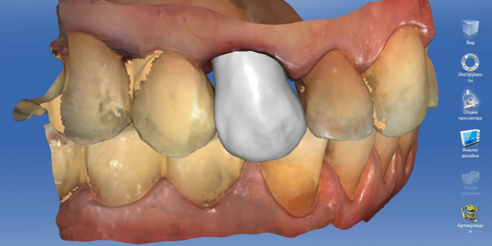 Восстановление утраченных тканей зуба коронкой Cerec - фото №3