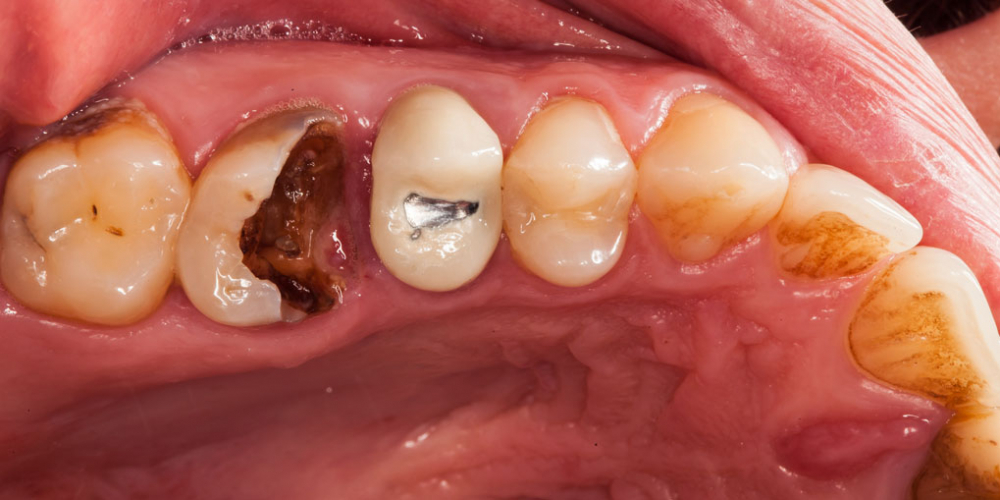 Восстановление зуба цельнокерамической коронкой - фото №1