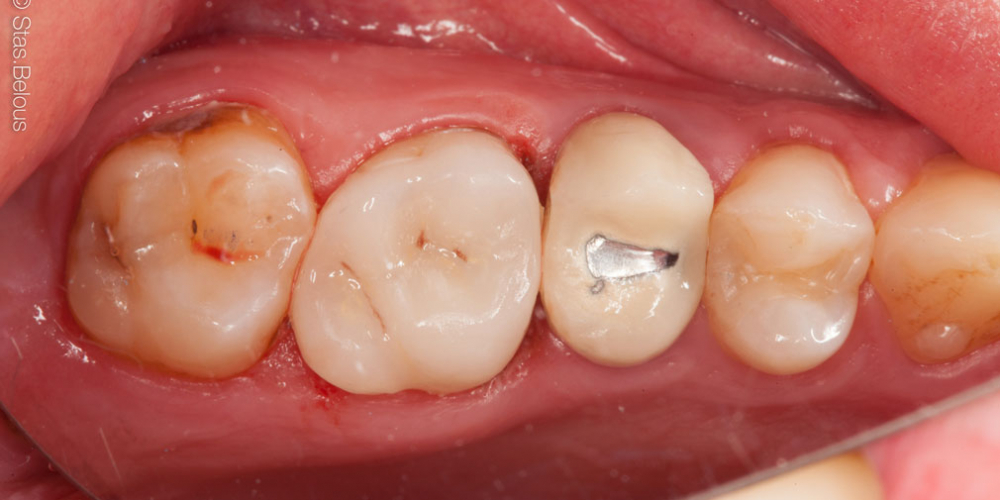 Восстановление зуба цельнокерамической коронкой - фото №4