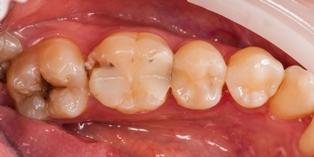 Начали лечение кариеса на одном зубе, а в итоге сделали - 2, цельнокерамическими вкладками - фото №1