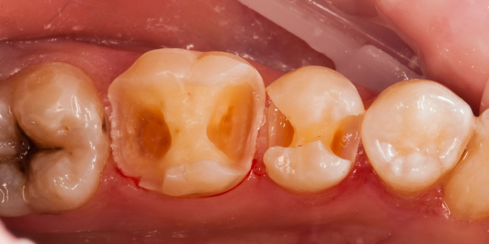 Начали лечение кариеса на одном зубе, а в итоге сделали - 2, цельнокерамическими вкладками - фото №4