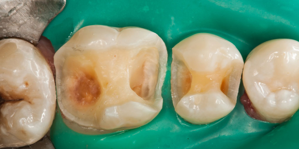 Начали лечение кариеса на одном зубе, а в итоге сделали - 2, цельнокерамическими вкладками - фото №2