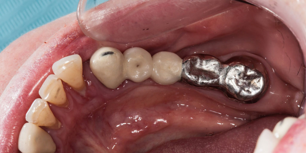 Протезирование зубов на имплантантах - фото №1