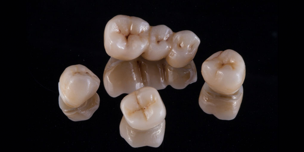 Протезирование зубов на имплантантах - фото №2