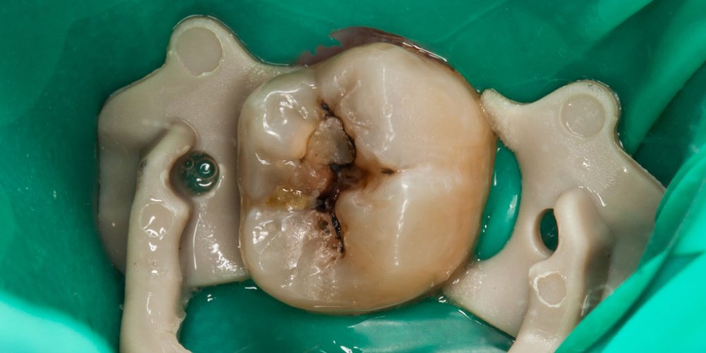 Результат лечения кариеса и реставрация жевательного зуба 38 - фото №1