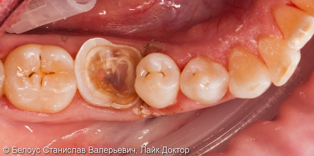 Установка коронок на разрушенные зубы - фото №5