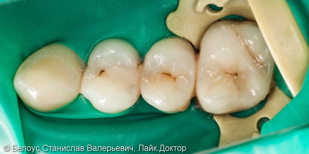 Замена старой реставрации (лечение кариеса) на 25 зубе, до и после - фото №1