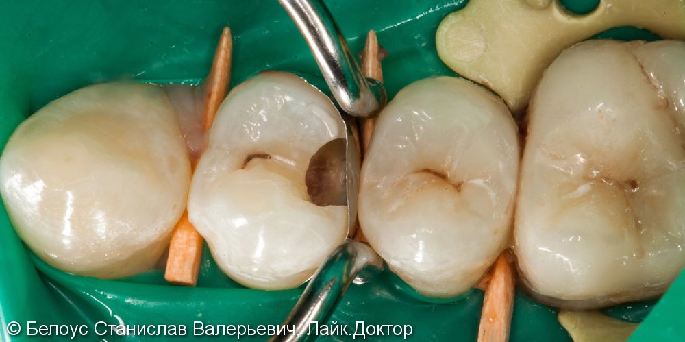 Замена старой реставрации (лечение кариеса) на 25 зубе, до и после - фото №2