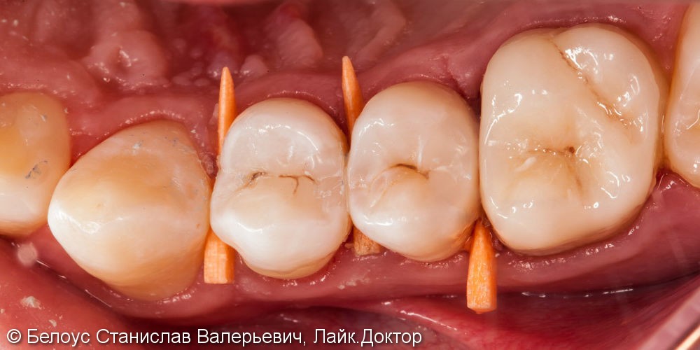 Замена старой реставрации (лечение кариеса) на 25 зубе, до и после - фото №3