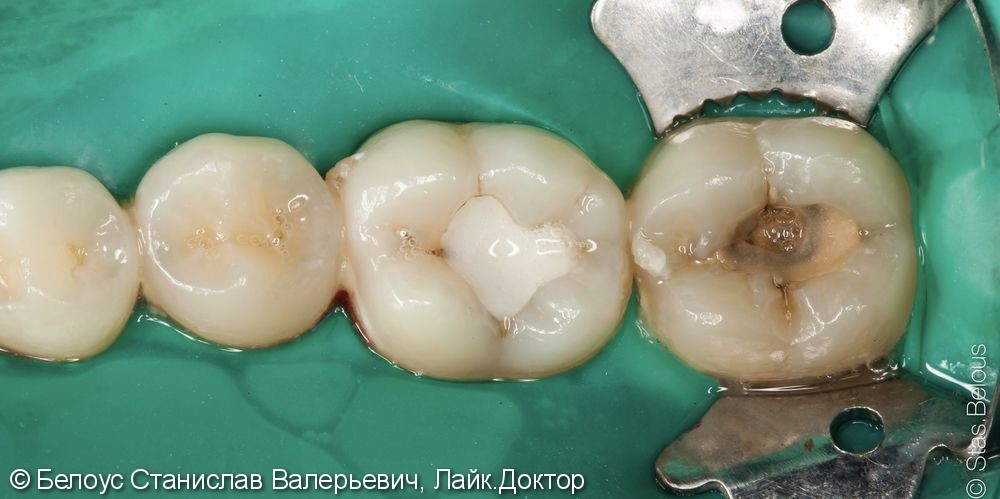 Лечение кариеса на жевательной поверхности 36 и 37 зубов - фото №1