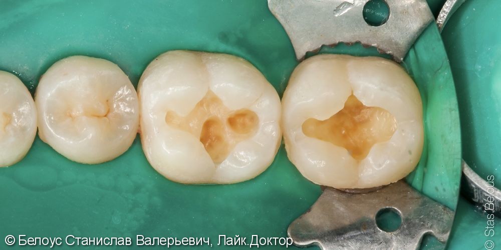 Лечение кариеса на жевательной поверхности 36 и 37 зубов - фото №2