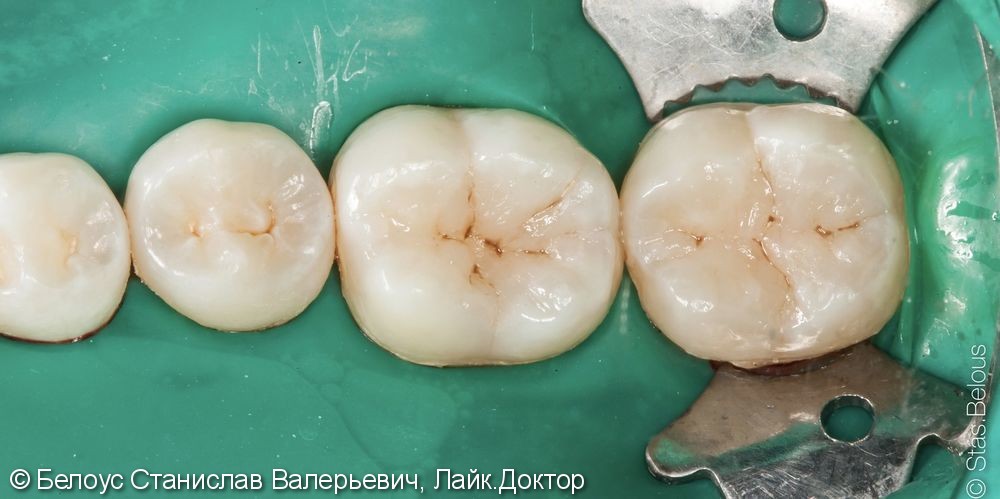 Лечение кариеса на жевательной поверхности 36 и 37 зубов - фото №3