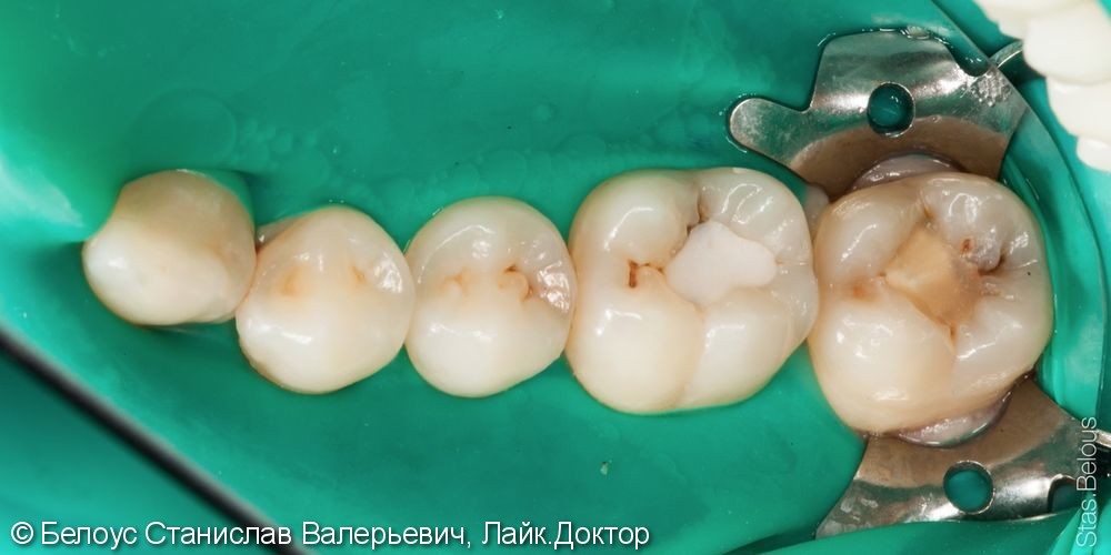Замена старых пломб на новые, результат до и после художественной реставрации зубов - фото №1