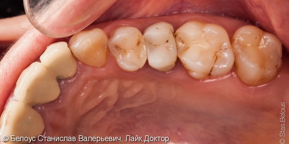 Установка цельнокерамических коронок на мертвые зубы, результат до и после - фото №1