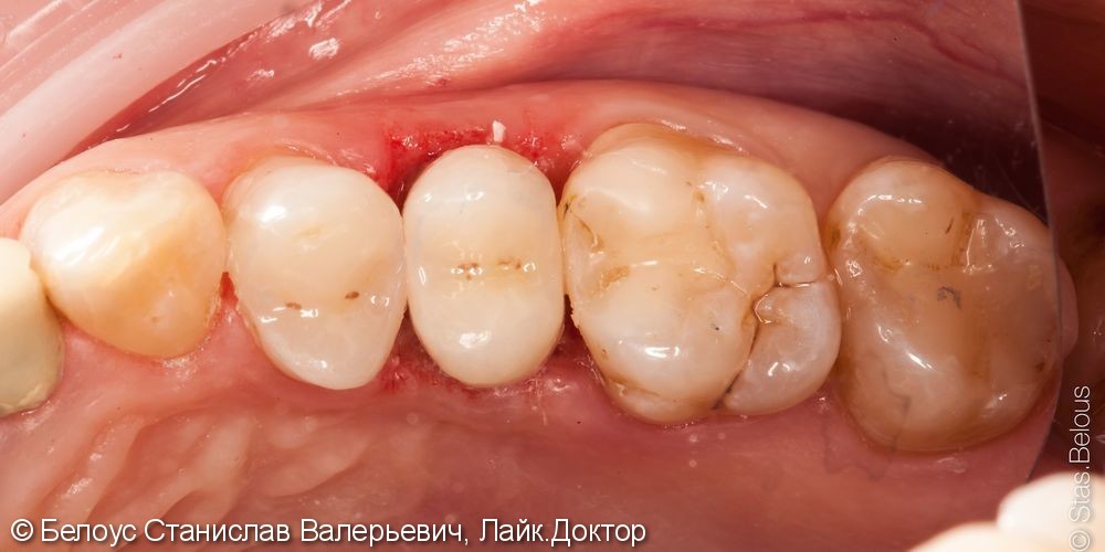 Установка цельнокерамических коронок на мертвые зубы, результат до и после - фото №4