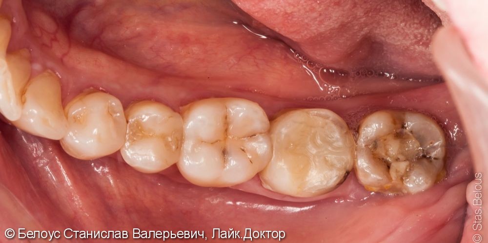Лечение пульпита 47 зуба и постановка коронки - фото №1