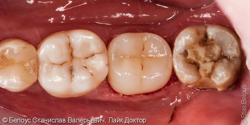 Лечение пульпита 47 зуба и постановка коронки - фото №4
