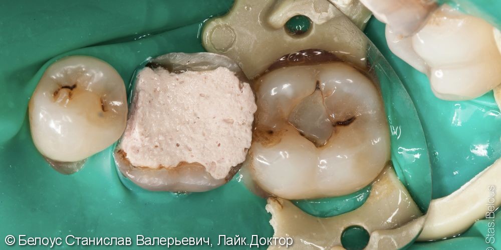 Лечение кариеса перед протезированием соседнего зуба - фото №1