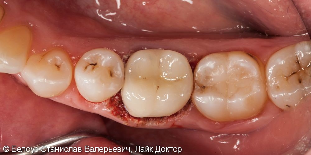 Перелечивание корневых каналов 46 зуба и установка коронки - фото №2