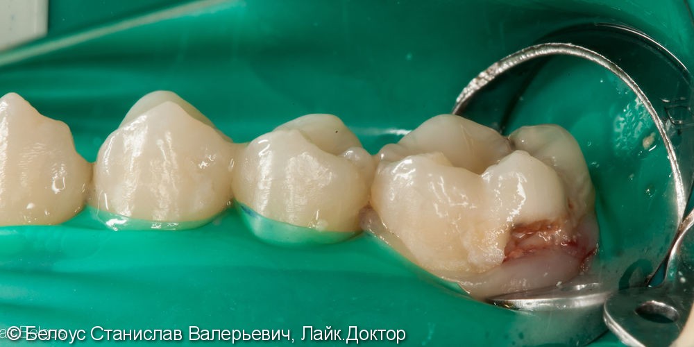 Кариес «за бугром» на боковой поверхности зуба, результат до и после - фото №1