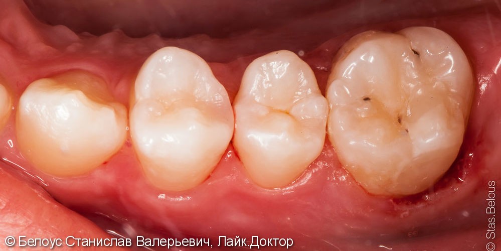 Кариес «за бугром» на боковой поверхности зуба, результат до и после - фото №4