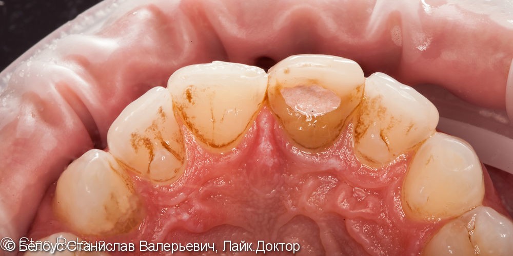 Чистка зубов и профессиональная гигиена полости рта - фото №1