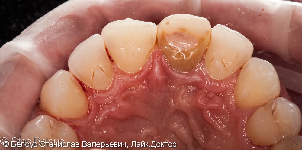 Чистка зубов и профессиональная гигиена полости рта - фото №2