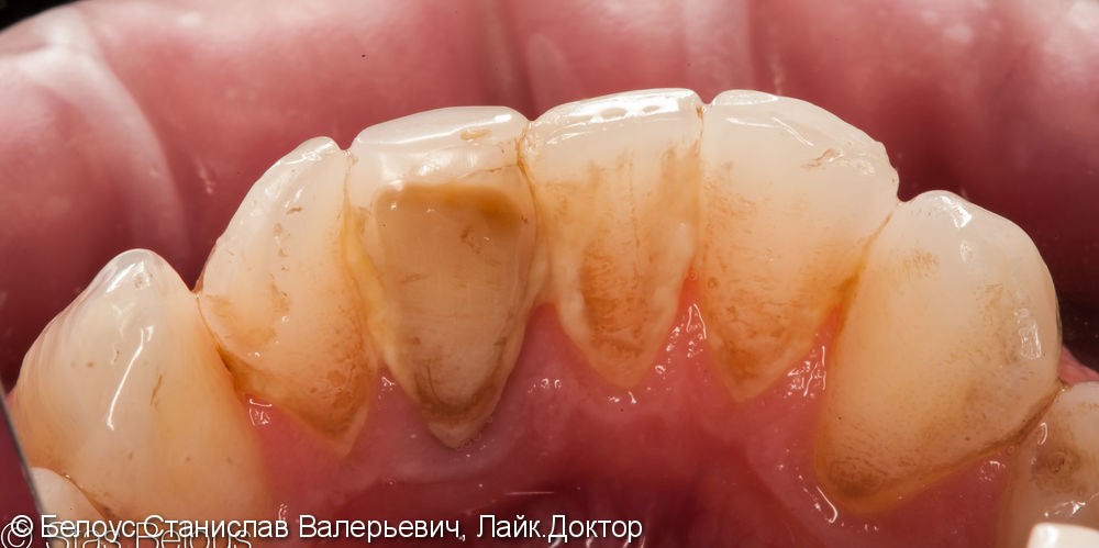 Удаление наддесневого и поддесневого зубного камня ультразвуком - фото №1