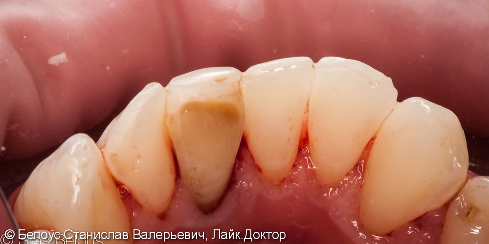 Удаление наддесневого и поддесневого зубного камня ультразвуком - фото №2