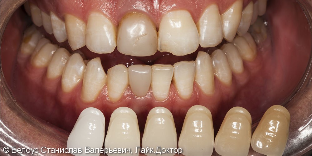Отбеливание зубов после лечения каналов и удаления нервов - фото №1