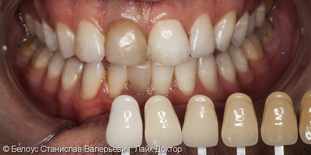 Отбеливание зубов после лечения каналов и удаления нервов - фото №2