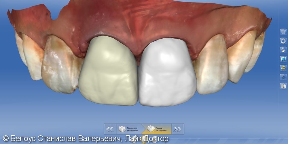 Керамические реставрации коронки виниры, до и после - фото №3