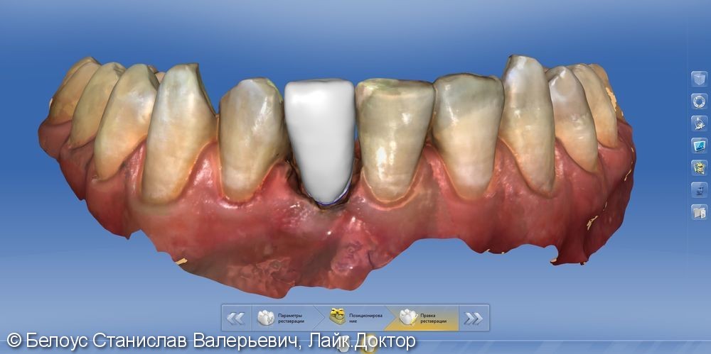 Керамические виниры коронки, переделка клинического случая - фото №5