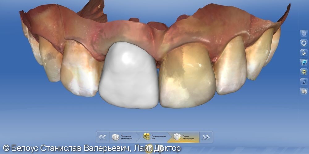 Керамические виниры коронки, переделка клинического случая - фото №6