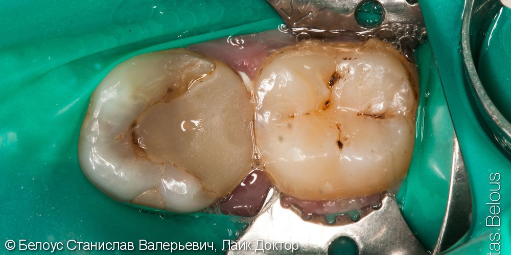Лечение корневых каналов зубов под микроскопом, до и после - фото №1