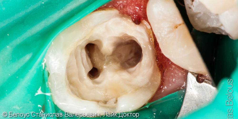Лечение корневых каналов зубов под микроскопом, до и после - фото №3