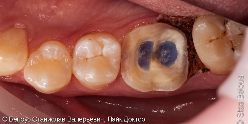 Установка коронки на зуб CAD/CAM, до и после - фото №1