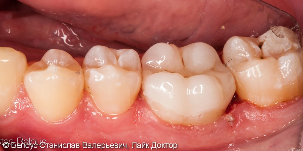 Установка коронки на зуб CAD/CAM, до и после - фото №4