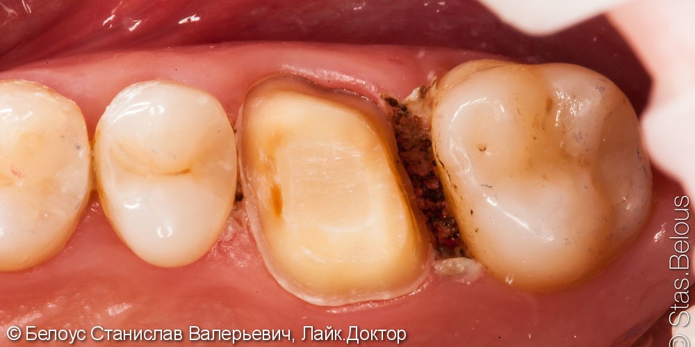 Установка цельнокерамической CAD/CAM коронки на зуб - фото №3