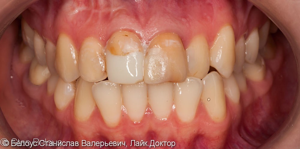 Лечение каналов зубов и установка временных коронок - фото №1