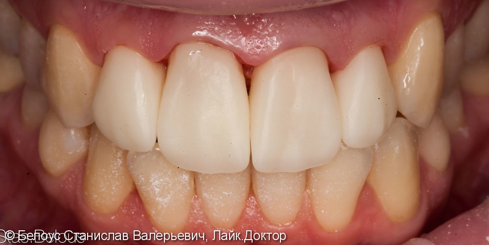 Лечение каналов зубов и установка временных коронок - фото №4
