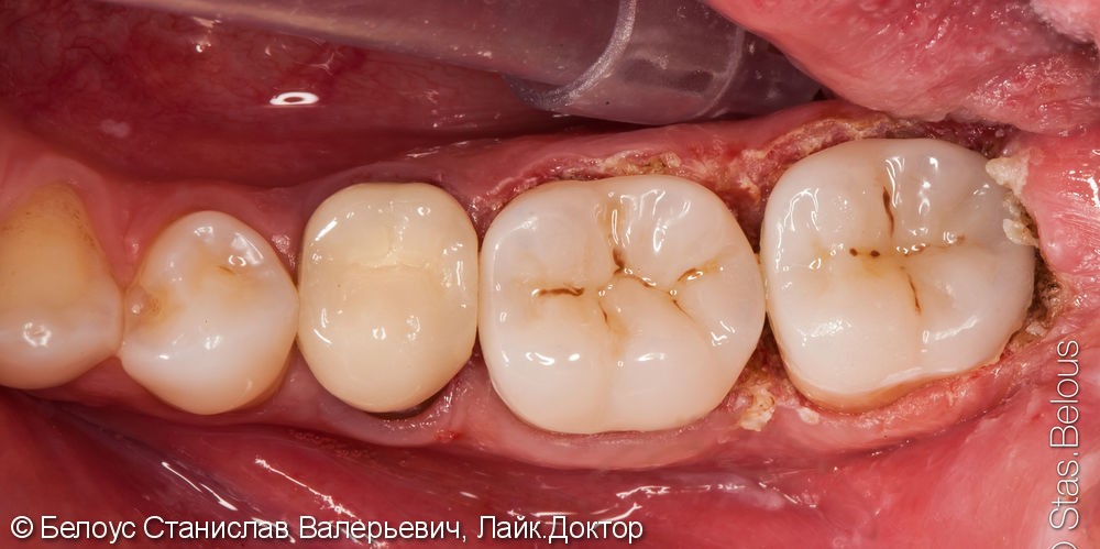 Лечение корневых каналов зубов и установка коронок - фото №5