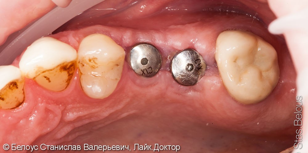 Протезирование зубов на имплантах - фото №1