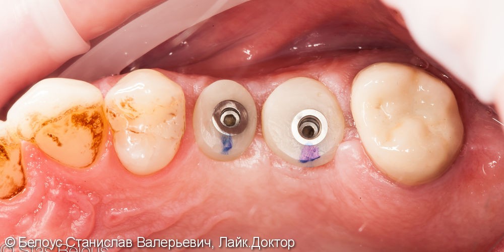 Протезирование зубов на имплантах - фото №2