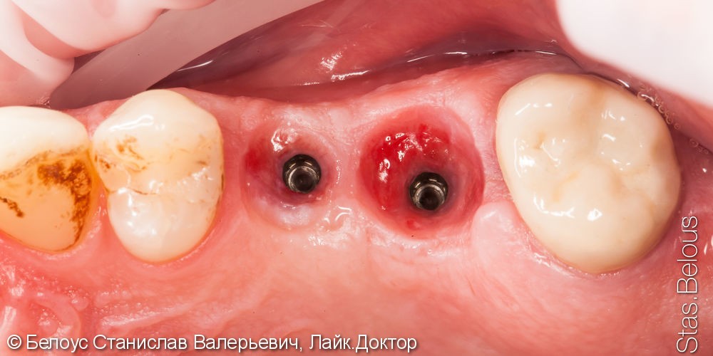 Протезирование зубов на имплантах - фото №3