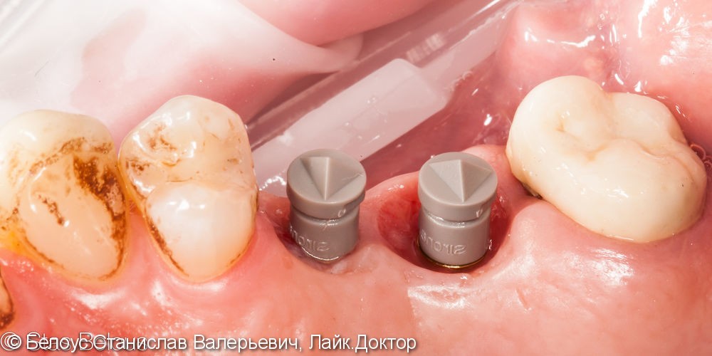 Протезирование зубов на имплантах - фото №4