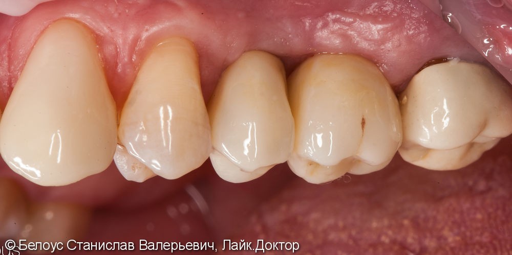 Протезирование зубов на имплантах - фото №10