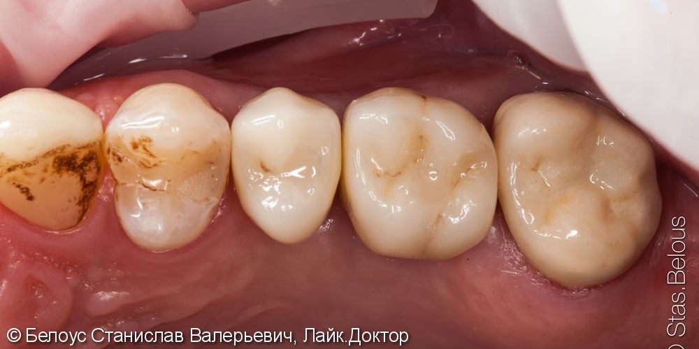 Протезирование зубов на имплантах - фото №11