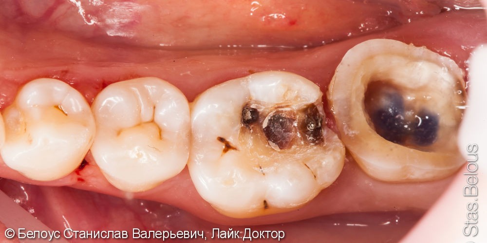 Лечение каналов, установка коронок из стеклокерамики на CAD/CAM - фото №2