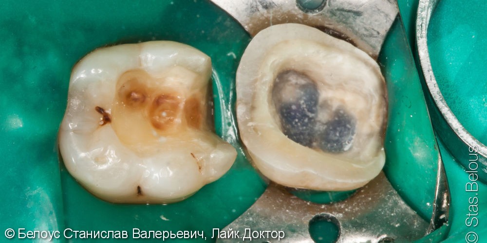 Лечение каналов, установка коронок из стеклокерамики на CAD/CAM - фото №4